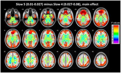 Amplitude of Low-Frequency Oscillations in Major Depressive Disorder With Childhood Trauma